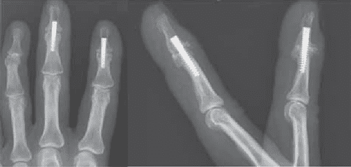 pdf-distal-interphalangeal-joint-arthrodesis-in-extension-using-a