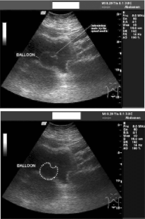 [PDF] TransAbdominal UltrasoundGuided Suprapubic Puncture of a Non