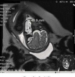 Figure 1 from Anesthesia for EXIT procedure (ex utero intrapartum ...
