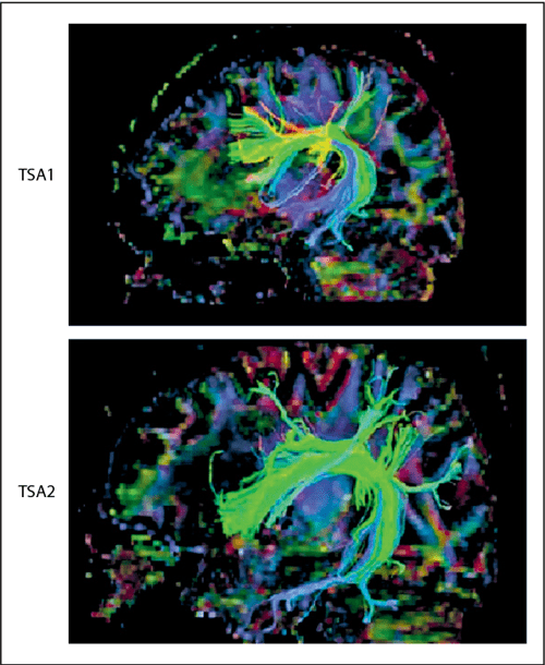 Transcortical Sensory Aphasia after Left Frontal Lobe Infarction Loss