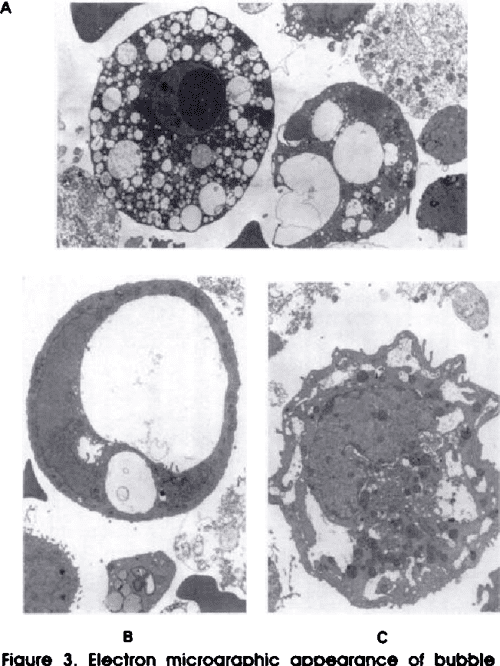[PDF] Bubble cells renal tubular cells in the urinary sediment with