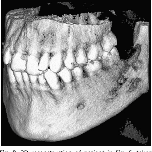 Figure 19 from Alveolar osteitis and osteomyelitis of the jaws
