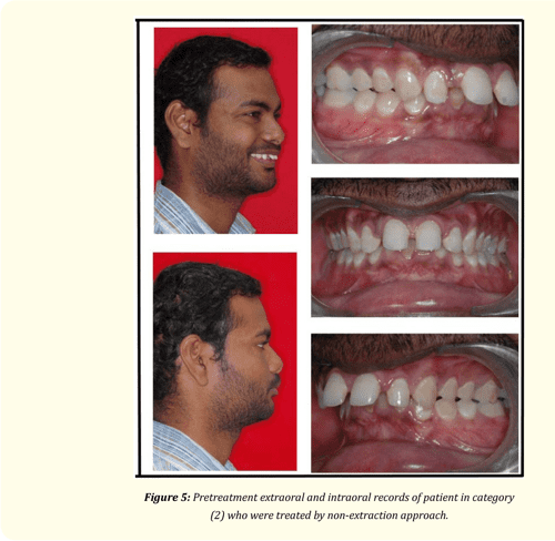Management of Skeletal Class II Malocclusion by Surgery-First Approach ...
