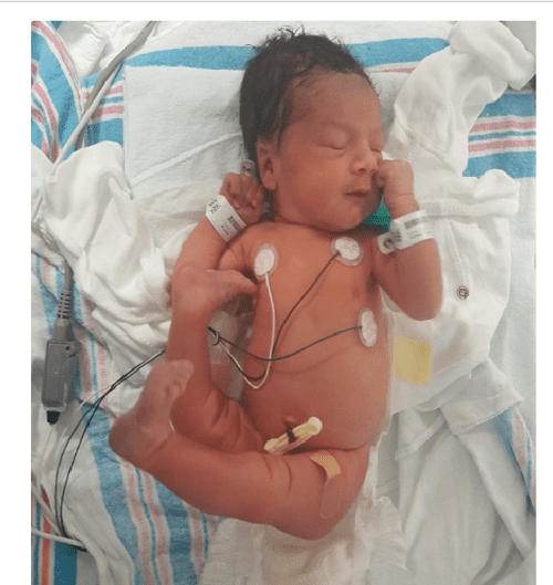 Congenital Bilateral Knee Hyperextension in a WellNewborn Infant