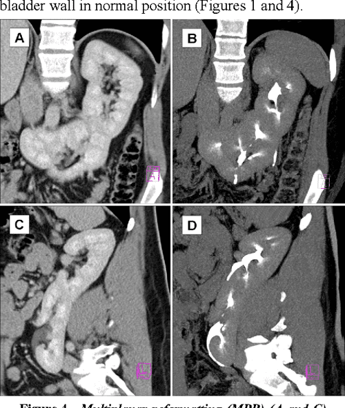Figure 2 from Left crossed fused renal ectopia Lshaped kidney type