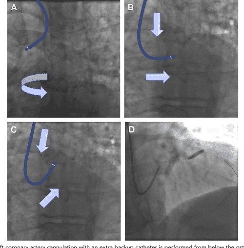 Diagnostic and Guide Catheter Selection and Manipulation for Radial