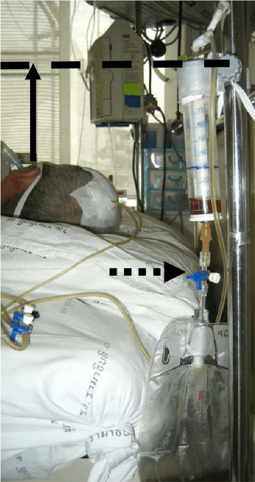 Ramathibodi external ventricular drainage collecting device. Semantic