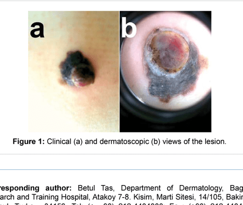  PDF Nodular Melanoma Like Superficial Spreading Melanoma Arising 