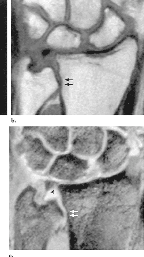 Figure 2 from Imaging findings in ulnarsided wrist impaction syndromes