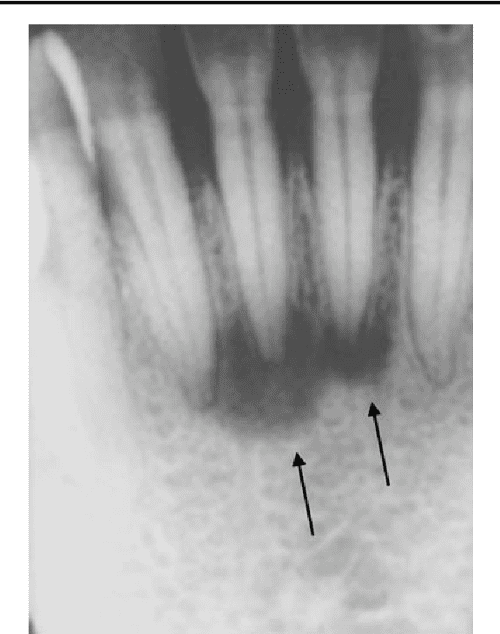 Cementoosseous dysplasia, a radiological mimic of periapical dental