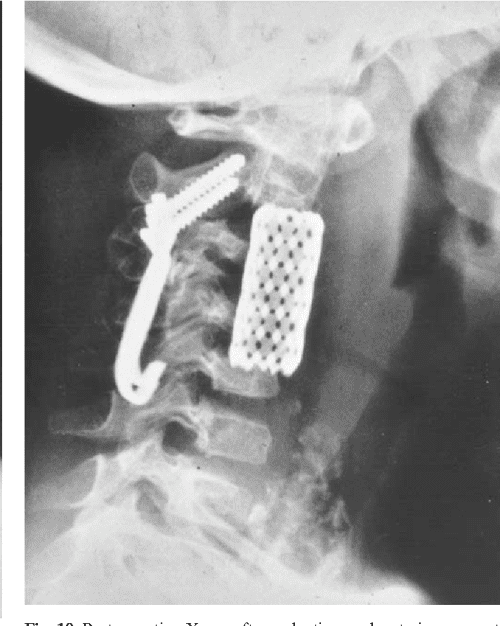 Titanium mesh cages (TMC) in spine surgery Semantic Scholar