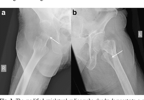 Hip fracture treatment elderly image