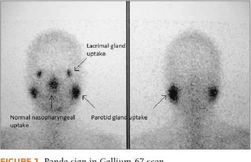 Ocular and parotid sarcoidosis - panda sign. | Semantic Scholar