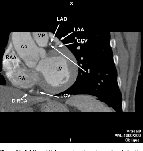 CT Anatomy of the heart Semantic Scholar