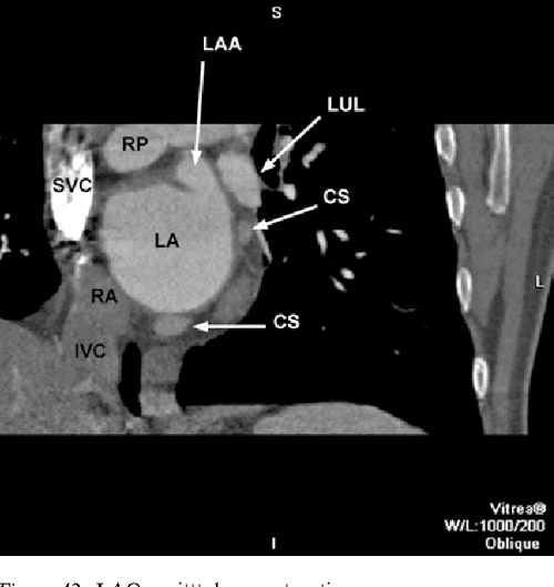 CT Anatomy of the heart | Semantic Scholar