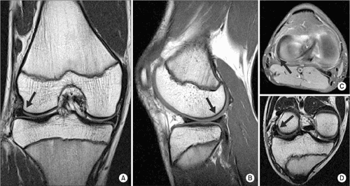Where is meniscus pain located image
