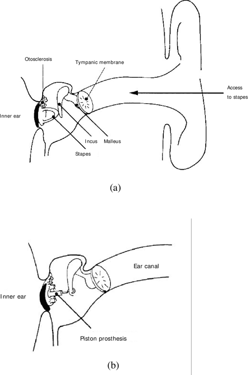 Estimation of the stapesbone thickness in the stapedotomy surgical procedure using a machine