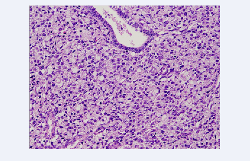 Figure 1 from A New Case of Primary Signet Ring Cell Carcinoma of the ...
