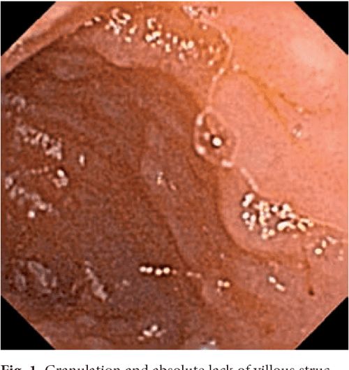 [PDF] The range of lesions in the small intestine of children with