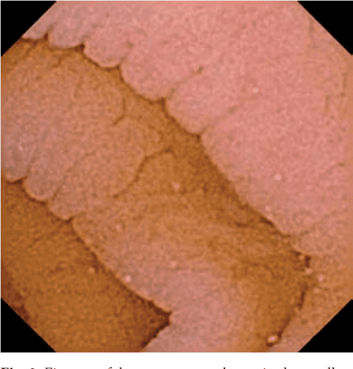 Figure 1 from The range of lesions in the small intestine of children