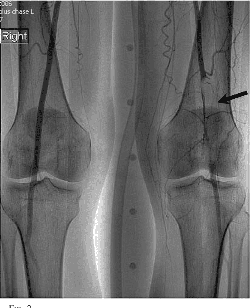 Figure 1 from HighPressure Water Jet Injury to the Neck and Arm Semantic Scholar
