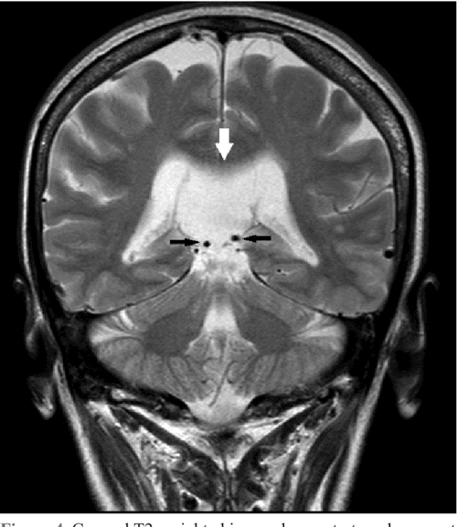 Figure 2 from Arachnoid cyst of the cavum velum interpositum associated