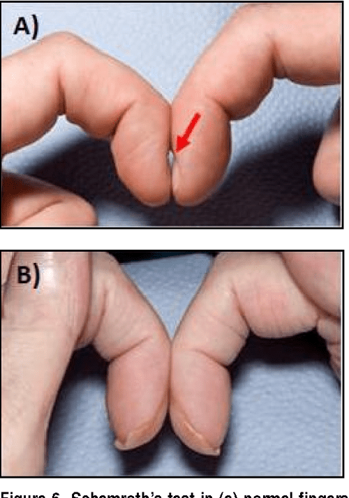 Figure 3 from Expert Review Examination for Finger Clubbing Semantic Scholar