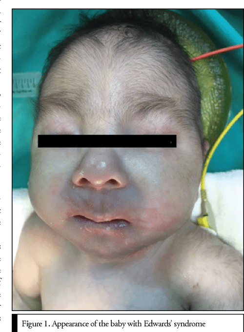 Figure 1 from Anaesthesia Management for Edward's Syndrome (Trisomy 18