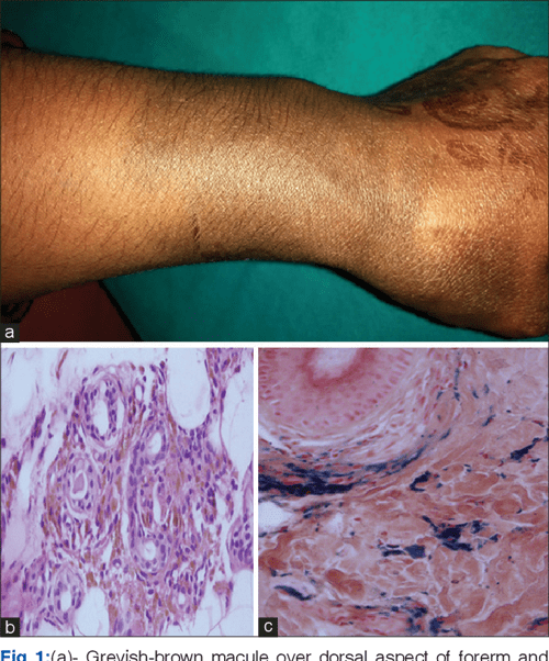 [PDF] Cutaneous siderosis after extravasation of intravenous iron