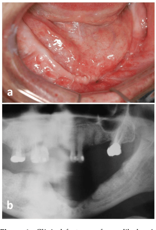 [PDF] A Rare Case of Mandibular Aspergillus Osteomyelitis in an