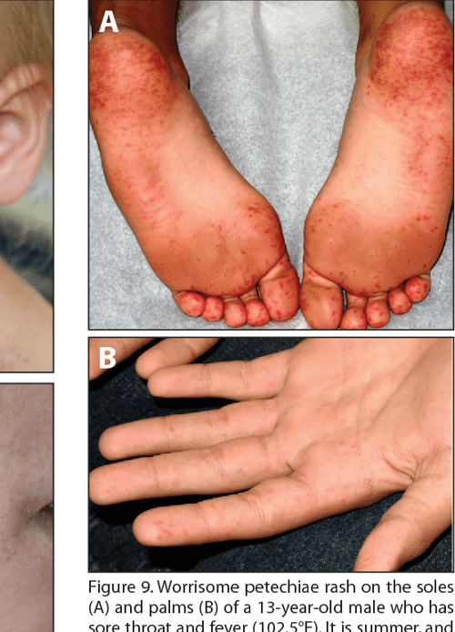 Figure 10 from Petechiae and purpura the ominous and the notso