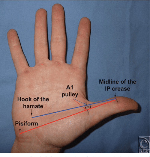 [PDF] Safe Treatment of Trigger Thumb With Longitudinal Anatomic Landmarks Semantic Scholar