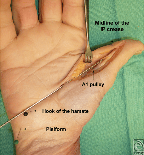 Figure 1 from Safe Treatment of Trigger Thumb With Longitudinal