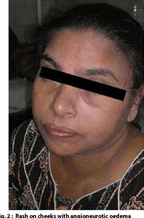 Allopurinol Induced DRESS Syndrome. Semantic Scholar