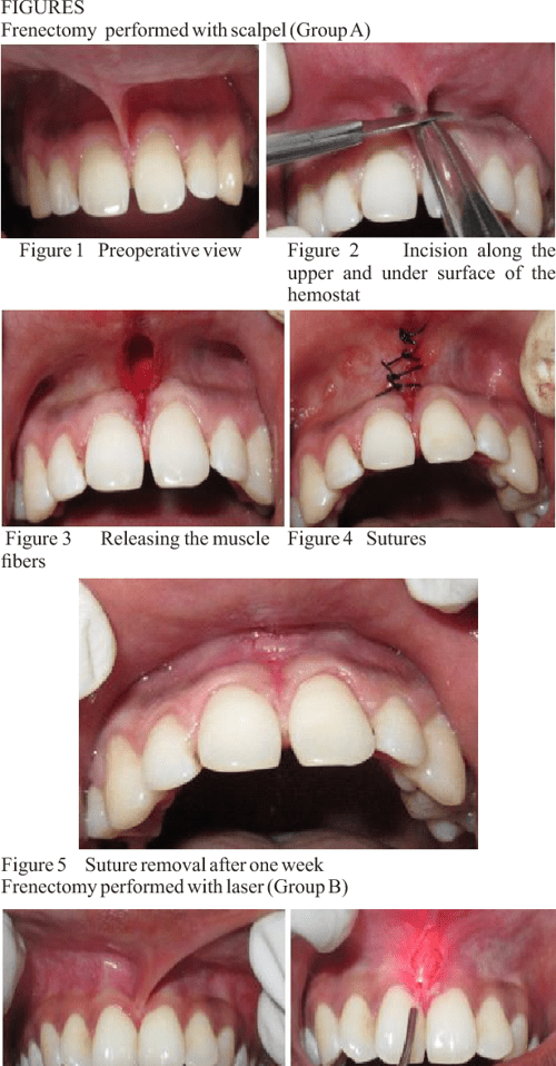 COMPARATIVE EVALUATION OF FRENECTOMY PROCEDURES PERFORMED WITH SCALPEL