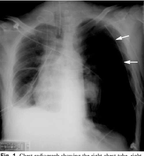 [PDF] Tension pneumothorax complicated by doublelumen endotracheal