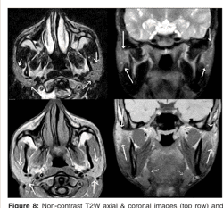 Innervation of parotid gland image