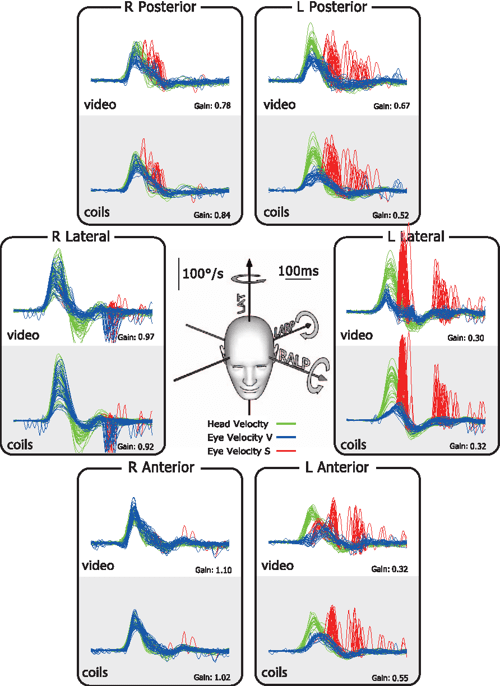 Figure 5 from The Video Head Impulse Test (vHIT) Detects Vertical