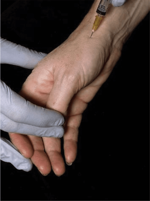 Joint aspiration and injection and synovial fluid analysis. Semantic