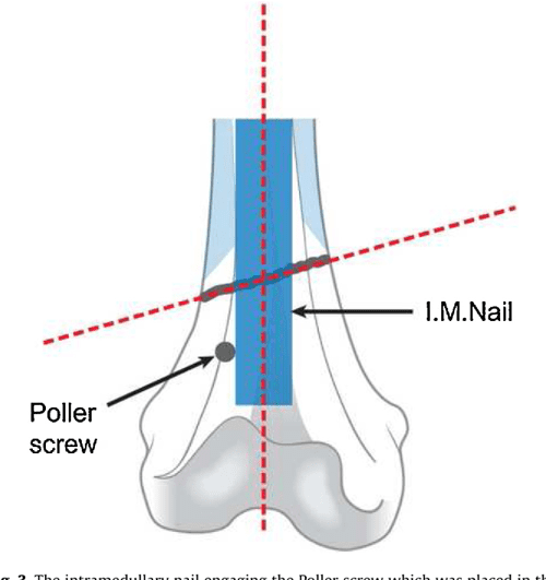 A novel technique for accurate Poller (blocking) screw placement