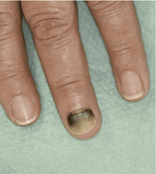 Figure 2 from Green Nail Syndrome (Pseudomonas aeruginosa Nail