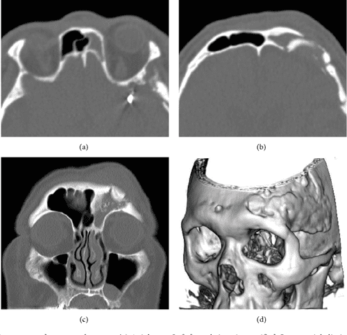 Sinusitis statistics picture