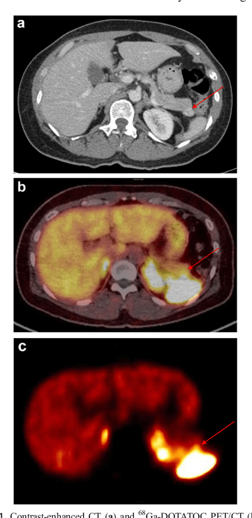 Spleen Scan for 68GaDOTATOC PETPositive Pancreatic Tail Lesion