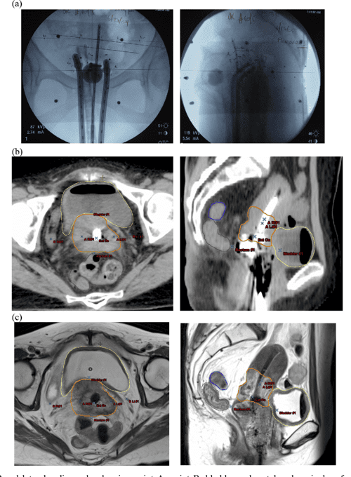 ImageBased Brachytherapy for the Treatment of Cervical Cancer