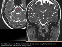Figure 2 from Imaging in neurovascular conflict of the trigeminal nerve ...