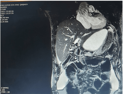 Table 1 From Acute Abdomen With Jaundice A Clue To Extrahepatic 