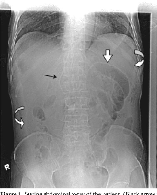 Figure 1 From Pneumoperitoneum On Supine Abdominal X Ray Case Report 