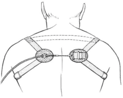 [PDF] Harness patterns for upper-extremity prostheses. | Semantic Scholar