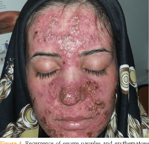 Erythromycin for rosacea reviews picture
