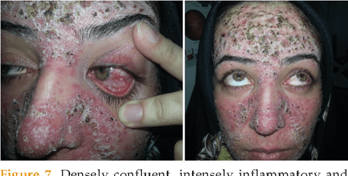 Rosacea clinical trials image